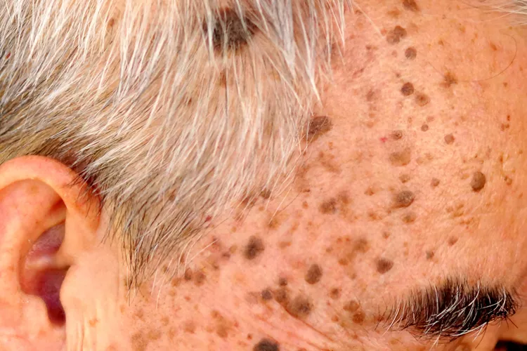 Foto principal de Queratosis seborreica